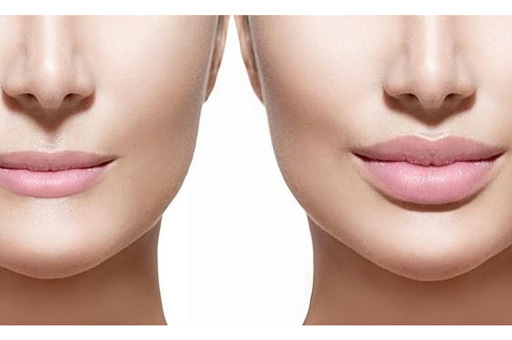 Two images showing Lip fillers